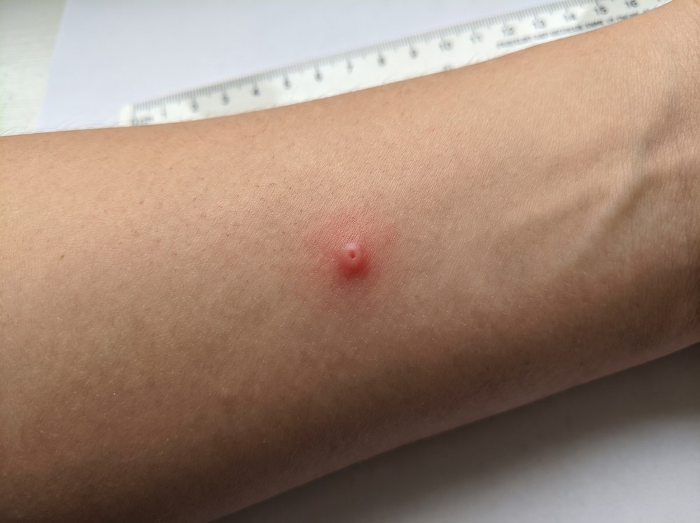 Close-up of a faint pink scratch-like mark on skin caused by a beetle's spiny legs, with no swelling or puncture visible